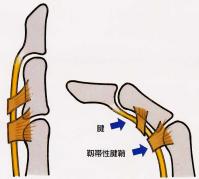 ばね指の症状が出やすい場所
